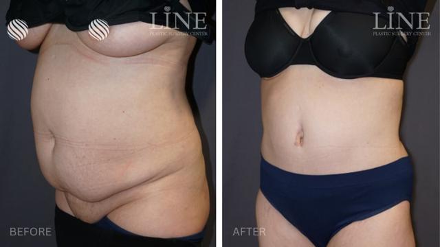 Tummy Tuck result at Line Plastic Surgery Irvine in Irvine, CA
