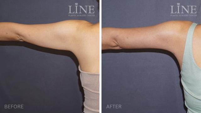 Liposuction result at Line Plastic Surgery Irvine in Irvine, CA