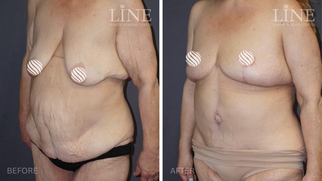 Mommy Makeover result at Line Plastic Surgery Irvine in Irvine, CA