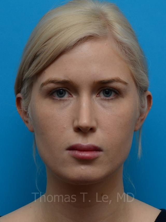 Functional Rhinoplasty after at Baltimore-Washington Facial Plastic Surgery & Medical Spa: Thomas T. Le, MD in Ellicott City, MD