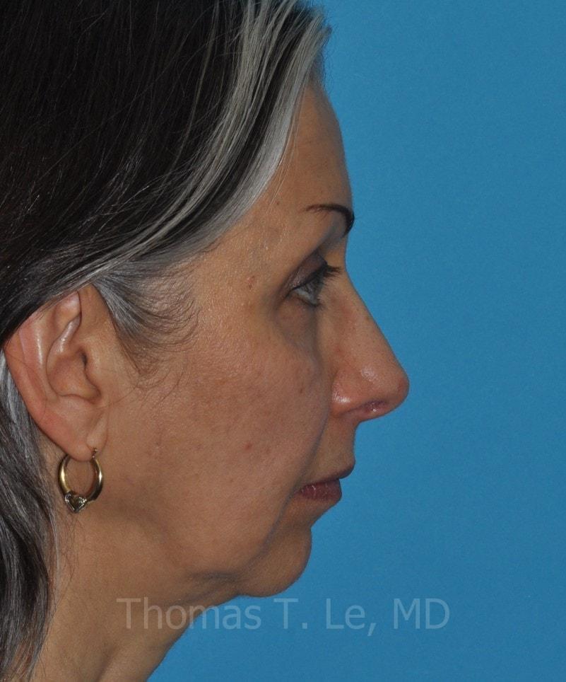 Baltimore-Washington Facial Plastic Surgery & Medical Spa: Thomas T. Le, MD rhinoplasty after — Ellicott City, MD