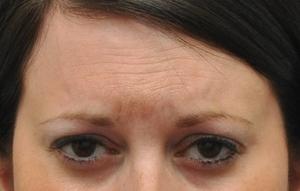 Botox before at Baltimore-Washington Facial Plastic Surgery & Medical Spa: Thomas T. Le, MD in Ellicott City, MD