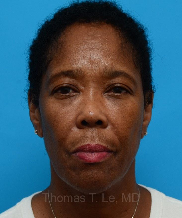 Baltimore-Washington Facial Plastic Surgery & Medical Spa: Thomas T. Le, MD cheek filler after — Ellicott City, MD