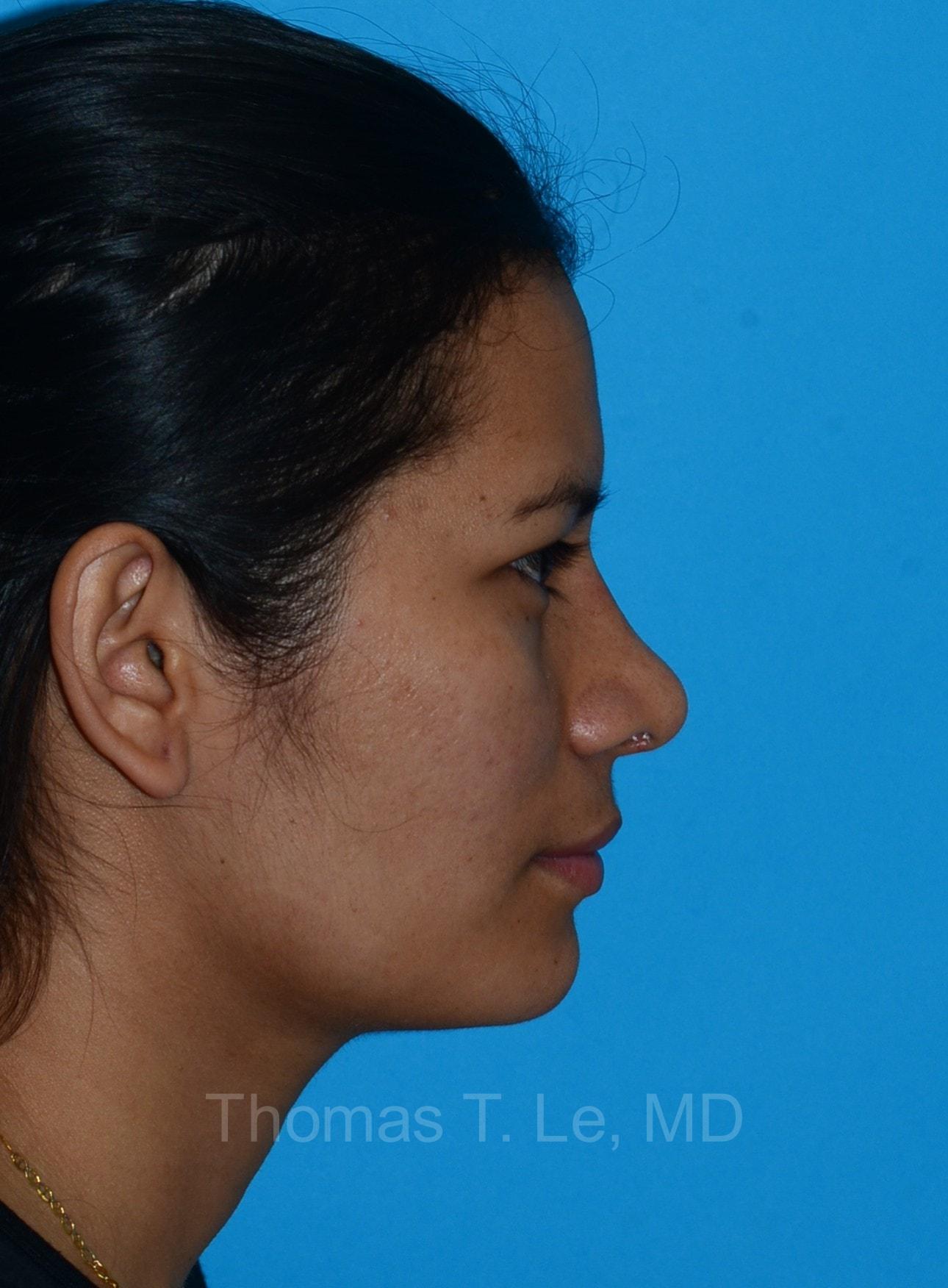 Baltimore-Washington Facial Plastic Surgery & Medical Spa: Thomas T. Le, MD rhinoplasty after — Ellicott City, MD