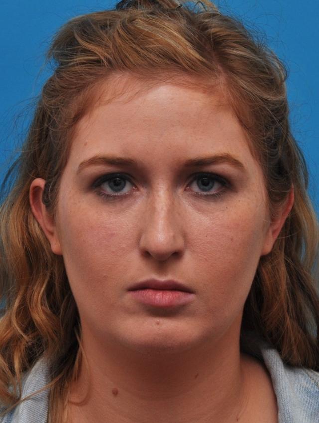 Functional Rhinoplasty before at Baltimore-Washington Facial Plastic Surgery & Medical Spa: Thomas T. Le, MD in Ellicott City, MD