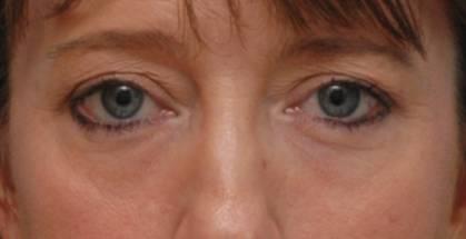 Blepharoplasty after at Baltimore-Washington Facial Plastic Surgery & Medical Spa: Thomas T. Le, MD in Ellicott City, MD
