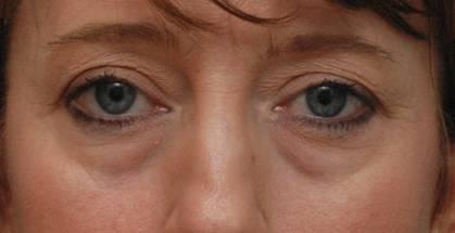 Blepharoplasty before at Baltimore-Washington Facial Plastic Surgery & Medical Spa: Thomas T. Le, MD in Ellicott City, MD