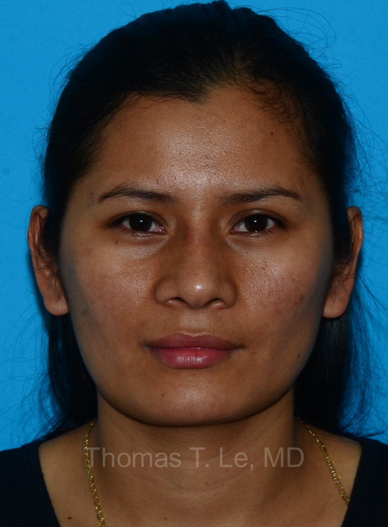 Baltimore-Washington Facial Plastic Surgery & Medical Spa: Thomas T. Le, MD rhinoplasty after — Ellicott City, MD
