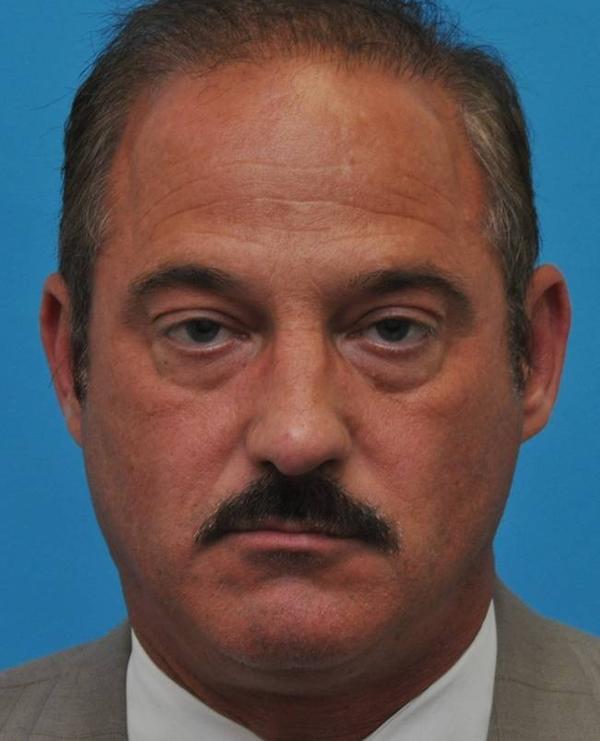 Blepharoplasty before at Baltimore-Washington Facial Plastic Surgery & Medical Spa: Thomas T. Le, MD in Ellicott City, MD