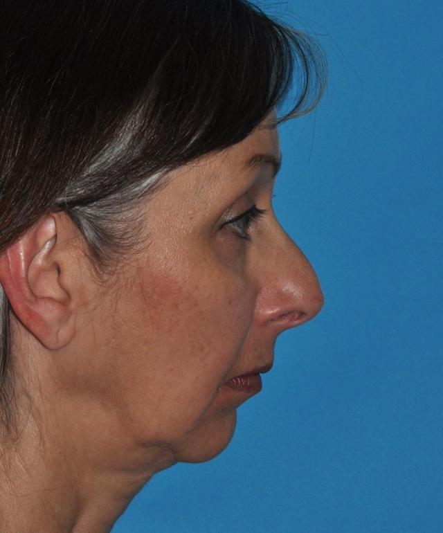 Functional Rhinoplasty before at Baltimore-Washington Facial Plastic Surgery & Medical Spa: Thomas T. Le, MD in Ellicott City, MD