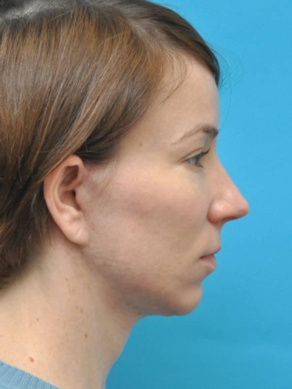 Baltimore-Washington Facial Plastic Surgery & Medical Spa: Thomas T. Le, MD facelift after — Ellicott City, MD