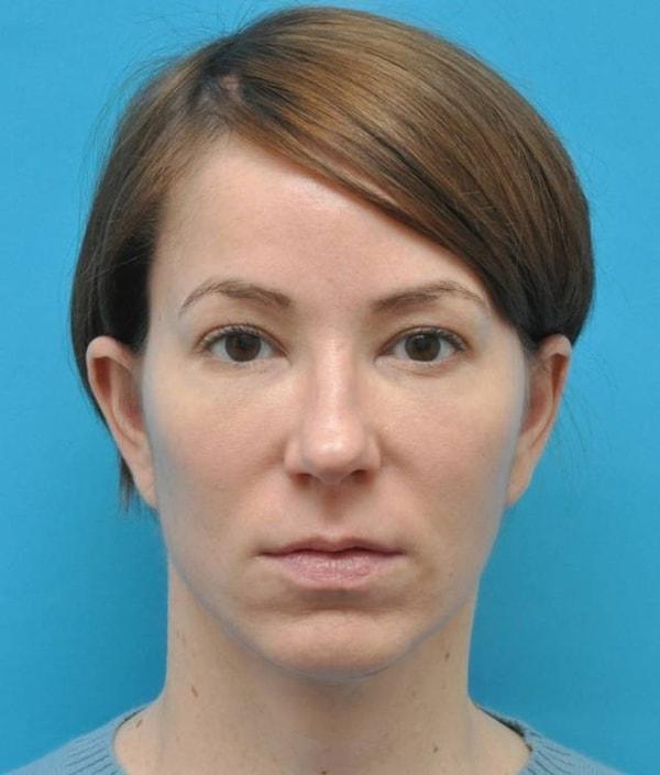 Baltimore-Washington Facial Plastic Surgery & Medical Spa: Thomas T. Le, MD facelift after — Ellicott City, MD