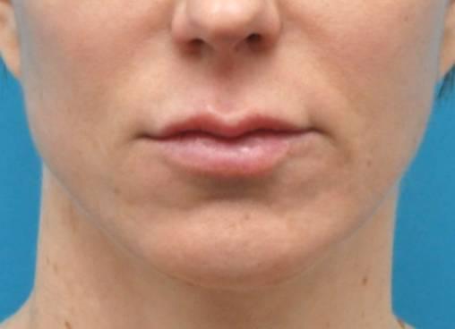 Baltimore-Washington Facial Plastic Surgery & Medical Spa: Thomas T. Le, MD after — Ellicott City, MD