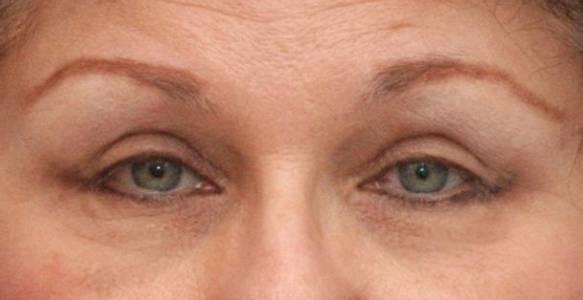 Blepharoplasty after at Baltimore-Washington Facial Plastic Surgery & Medical Spa: Thomas T. Le, MD in Ellicott City, MD