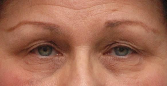 Blepharoplasty before at Baltimore-Washington Facial Plastic Surgery & Medical Spa: Thomas T. Le, MD in Ellicott City, MD