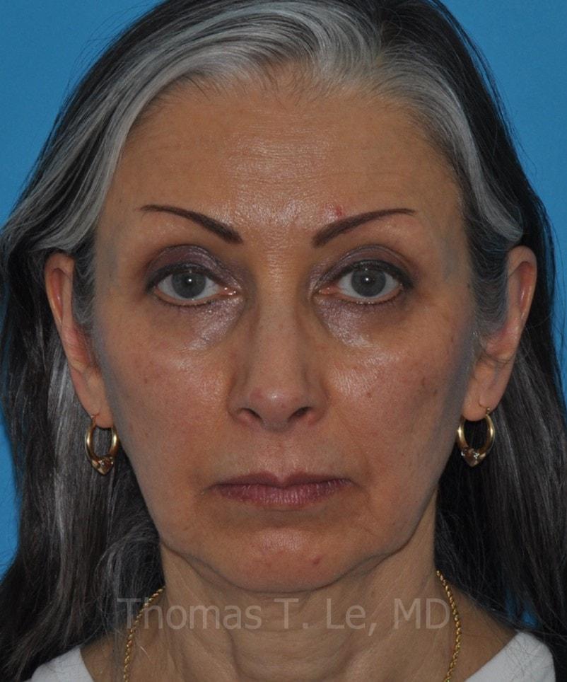 Baltimore-Washington Facial Plastic Surgery & Medical Spa: Thomas T. Le, MD rhinoplasty after — Ellicott City, MD