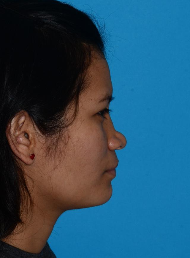 Functional Rhinoplasty before at Baltimore-Washington Facial Plastic Surgery & Medical Spa: Thomas T. Le, MD in Ellicott City, MD