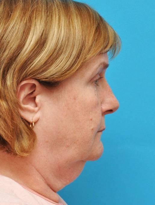Facelift before at Baltimore-Washington Facial Plastic Surgery & Medical Spa: Thomas T. Le, MD in Ellicott City, MD