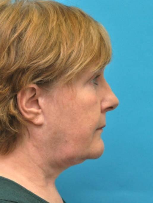 Facelift after at Baltimore-Washington Facial Plastic Surgery & Medical Spa: Thomas T. Le, MD in Ellicott City, MD