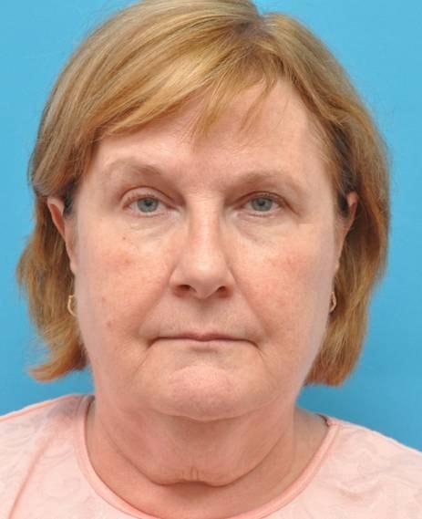 Facelift before at Baltimore-Washington Facial Plastic Surgery & Medical Spa: Thomas T. Le, MD in Ellicott City, MD