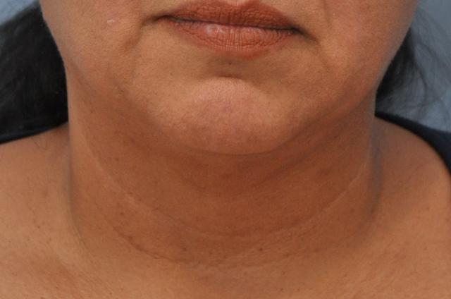 Kybella after at OC Facial Plastic Surgery - Ali Sepehr, MD in Newport Beach, CA