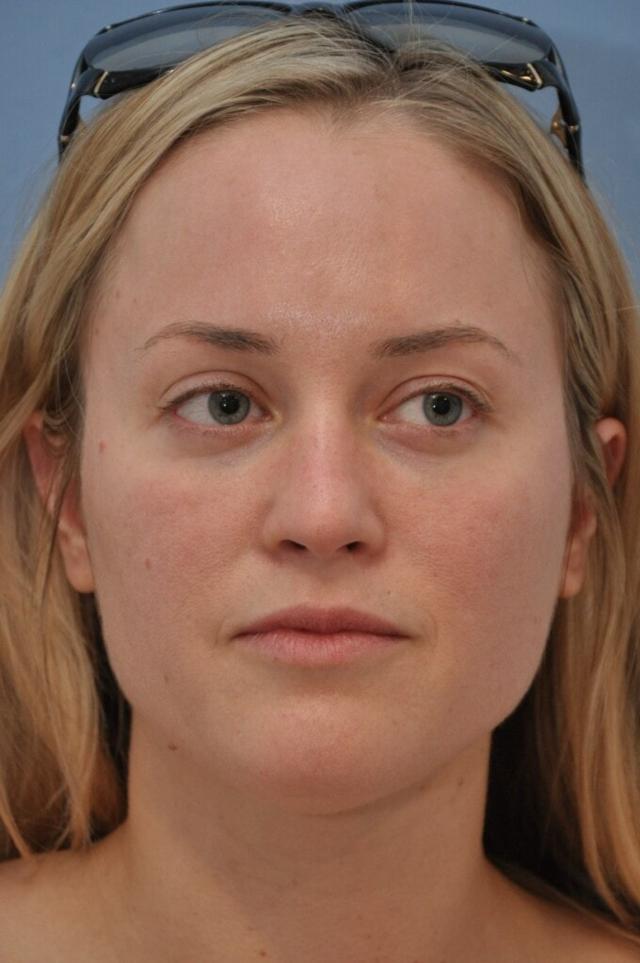 Kybella before at OC Facial Plastic Surgery - Ali Sepehr, MD in Newport Beach, CA