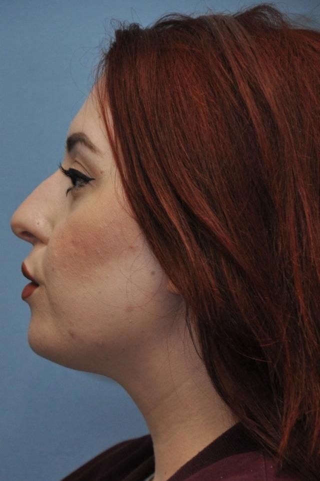 Kybella before at OC Facial Plastic Surgery - Ali Sepehr, MD in Newport Beach, CA