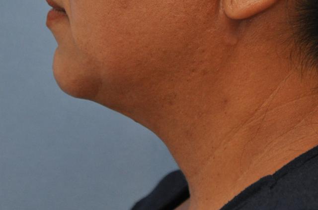 Kybella after at OC Facial Plastic Surgery - Ali Sepehr, MD in Newport Beach, CA