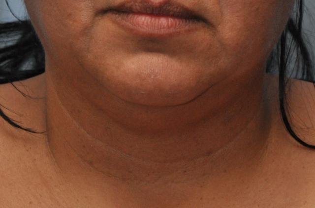 Kybella before at OC Facial Plastic Surgery - Ali Sepehr, MD in Newport Beach, CA