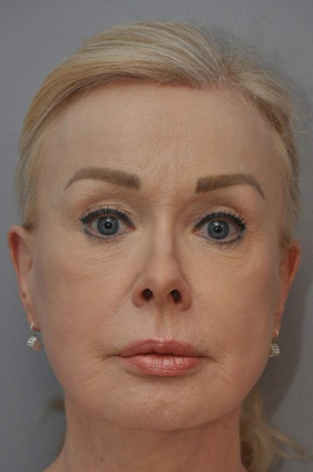 Brow Lift after at OC Facial Plastic Surgery - Ali Sepehr, MD in Newport Beach, CA