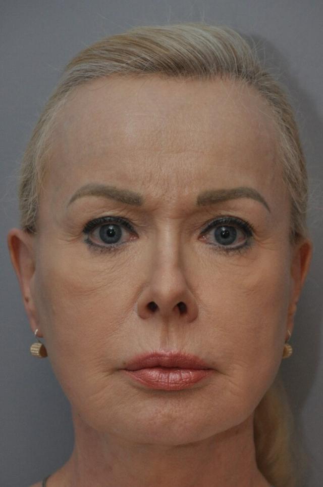 Brow Lift before at OC Facial Plastic Surgery - Ali Sepehr, MD in Newport Beach, CA