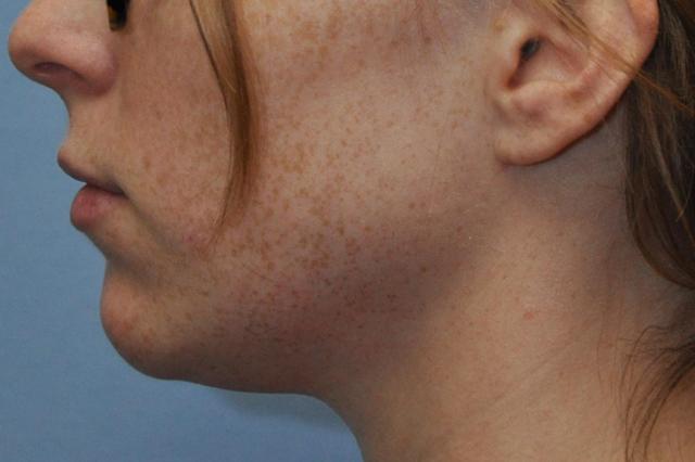 Kybella before at OC Facial Plastic Surgery - Ali Sepehr, MD in Newport Beach, CA