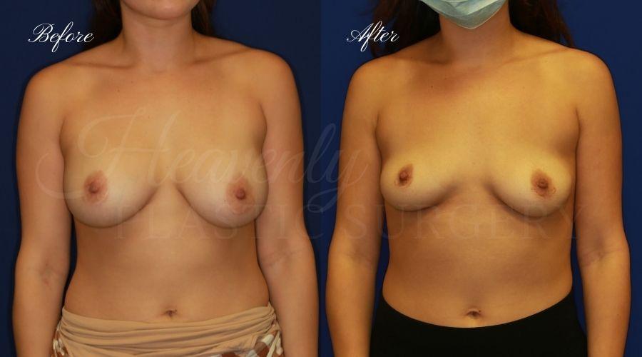 Heavenly Plastic Surgery result — Lake Forest, CA