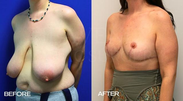 Breast Reduction result at Heavenly Plastic Surgery in Lake Forest, CA