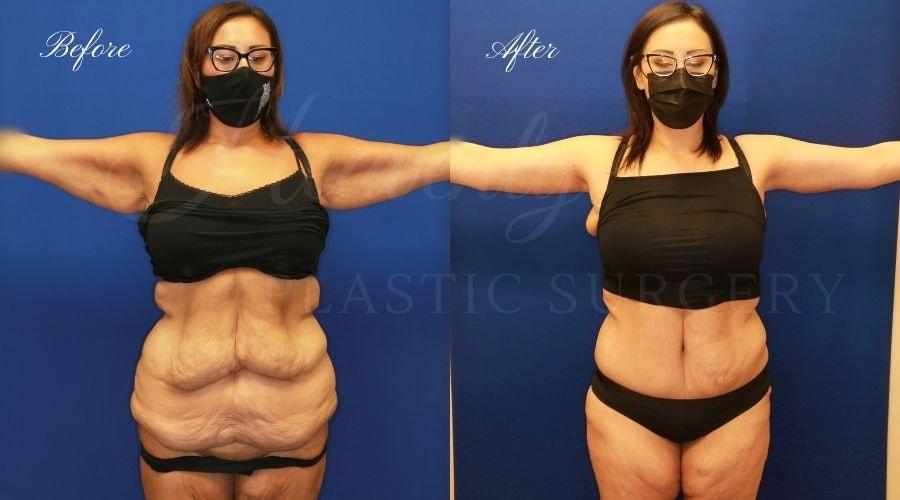 Heavenly Plastic Surgery tummy tuck result — Lake Forest, CA