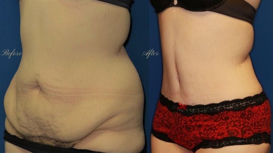 Heavenly Plastic Surgery tummy tuck result — Lake Forest, CA