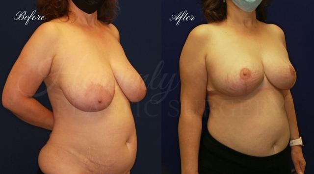 Breast Lift result at Heavenly Plastic Surgery in Lake Forest, CA