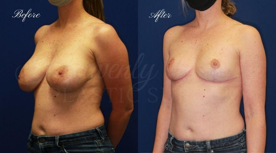 Heavenly Plastic Surgery result — Lake Forest, CA