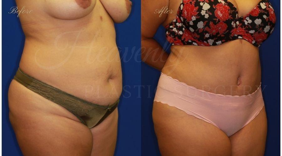 Heavenly Plastic Surgery tummy tuck result — Lake Forest, CA