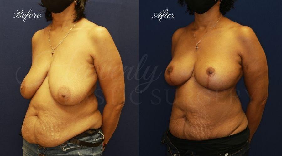 Heavenly Plastic Surgery breast lift result — Lake Forest, CA