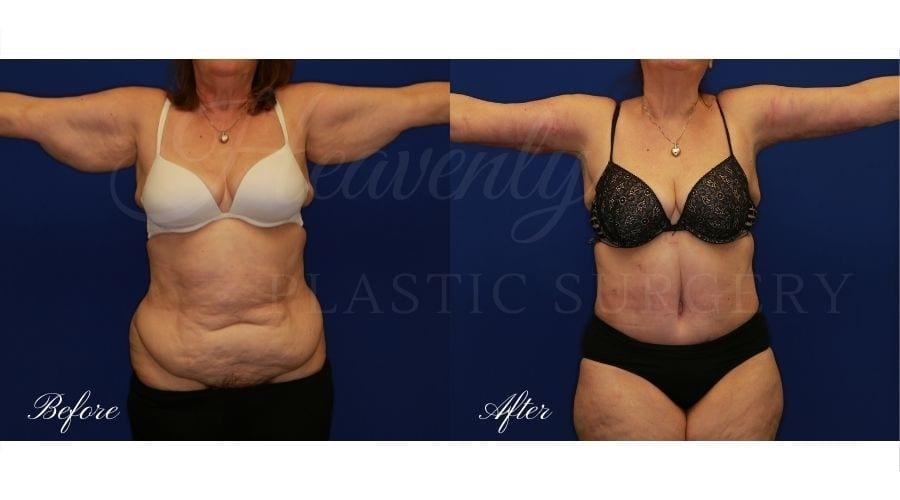 Heavenly Plastic Surgery tummy tuck result — Lake Forest, CA