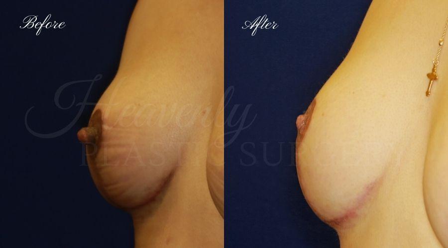 Heavenly Plastic Surgery result — Lake Forest, CA