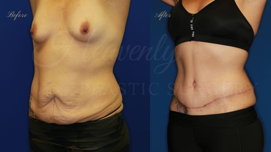 Heavenly Plastic Surgery tummy tuck result — Lake Forest, CA