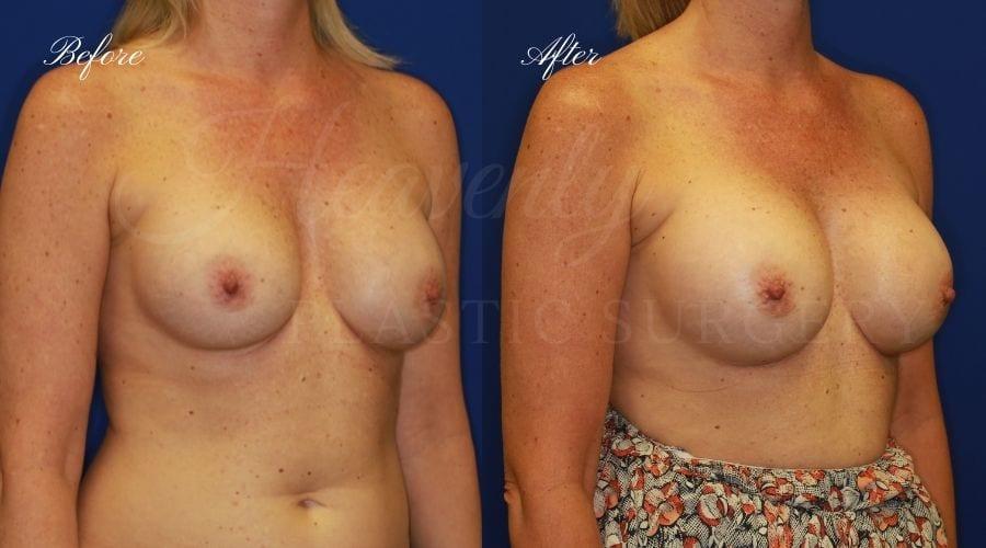 Heavenly Plastic Surgery result — Lake Forest, CA