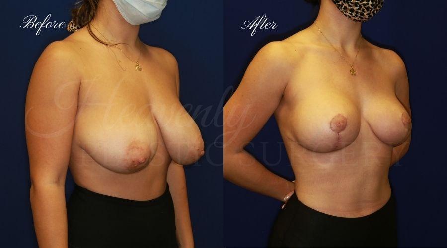 Heavenly Plastic Surgery breast lift result — Lake Forest, CA