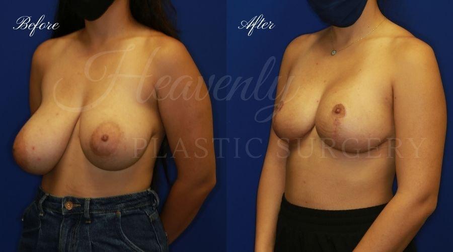 Heavenly Plastic Surgery breast lift result — Lake Forest, CA