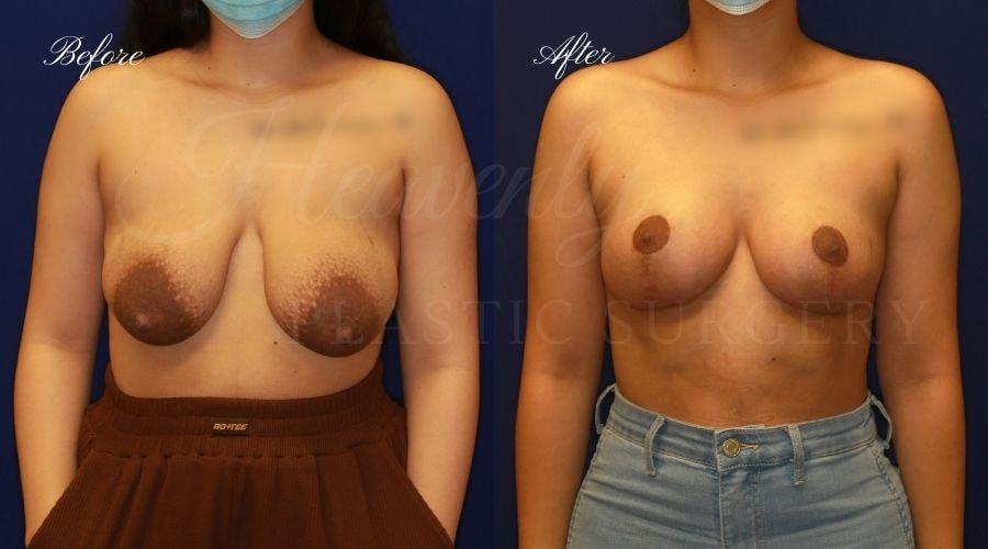 Heavenly Plastic Surgery breast lift result — Lake Forest, CA
