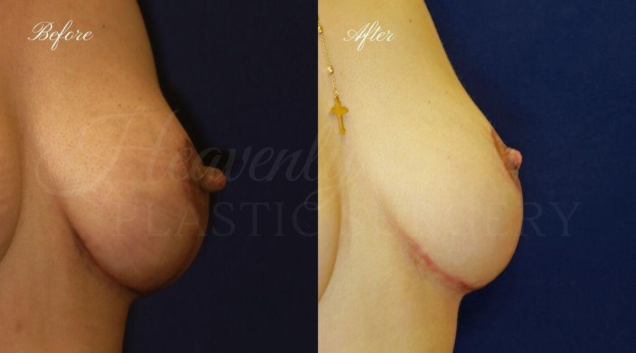 Heavenly Plastic Surgery result — Lake Forest, CA