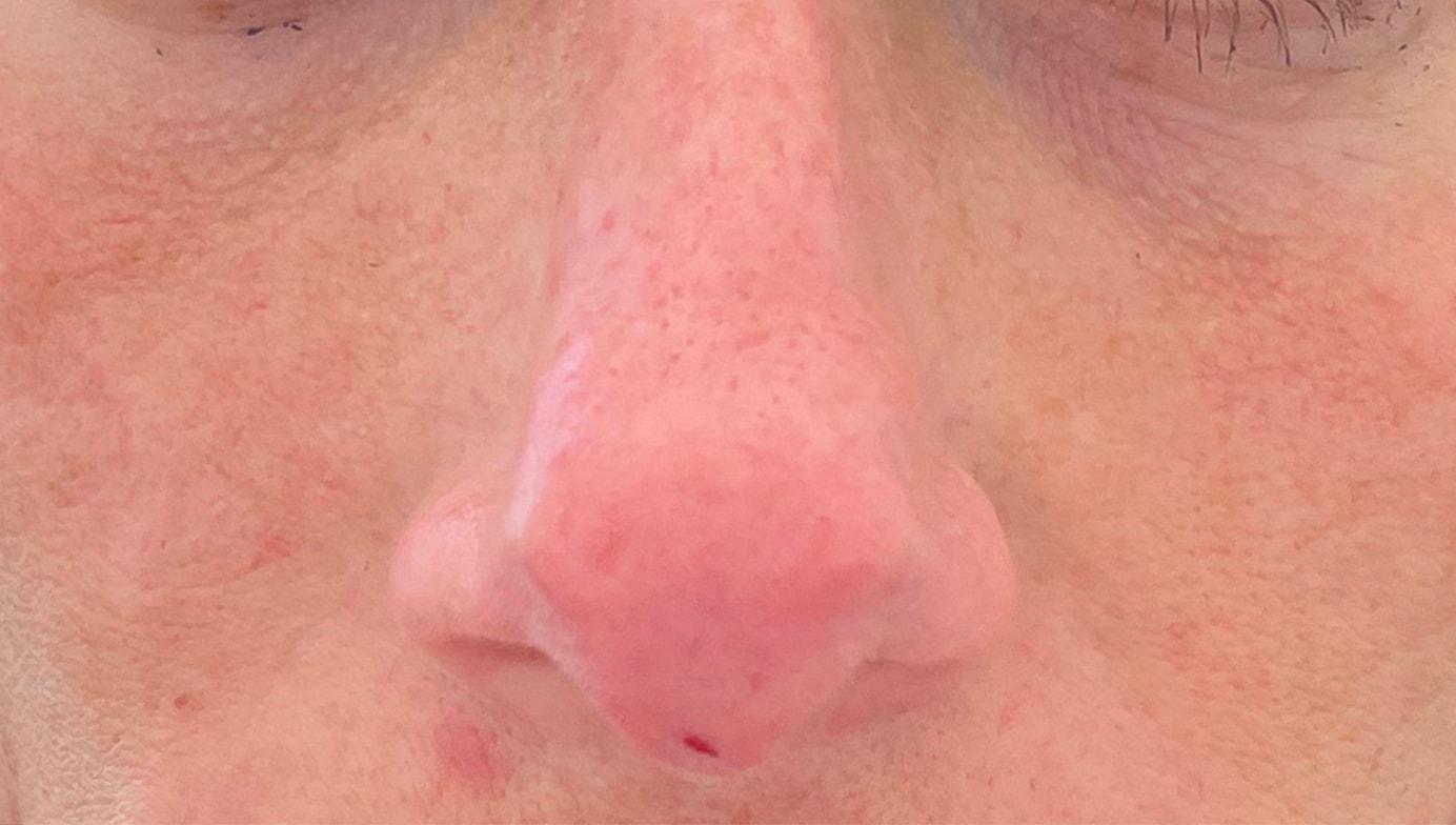 Shari Reitzen, MD liquid rhinoplasty after — New York, NY