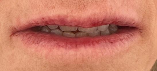 Shari Reitzen, MD lip filler after — New York, NY